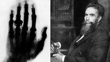 Das Röntgenbild der Hand des Anatomen Albert von Kölliker und Wilhelm Conrad Röntgen. Röntgen hat am 8. November 1895 in Würzburg die Röntgenstrahlung entdeckt. | Bild: picture-alliance/dpa/akg/Collage: BR