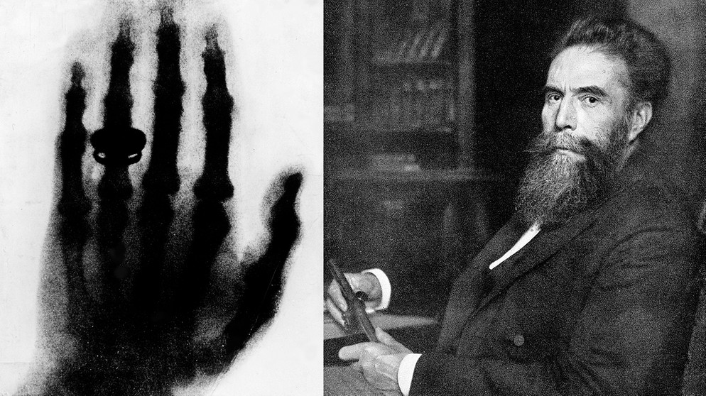 Das Röntgenbild der Hand des Anatomen Albert von Kölliker und Wilhelm Conrad Röntgen. Röntgen hat am 8. November 1895 in Würzburg die Röntgenstrahlung entdeckt. | Bild: picture-alliance/dpa/akg/Collage: BR