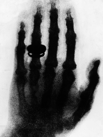 Röntgenbild von 1896: die Hand des Anatomen Albert von Kölliker. Die Aufnahme fertigte Wilhelm Conrad Röntgen am 23. Januar 1896 auf seinem ersten öffentlichen Vortrag über die Röntgenstrahlen an. Am 8. November 1895 hat er die Röntgenstrahlung in Würzburg entdeckt. | Bild: picture-alliance/dpa/akg