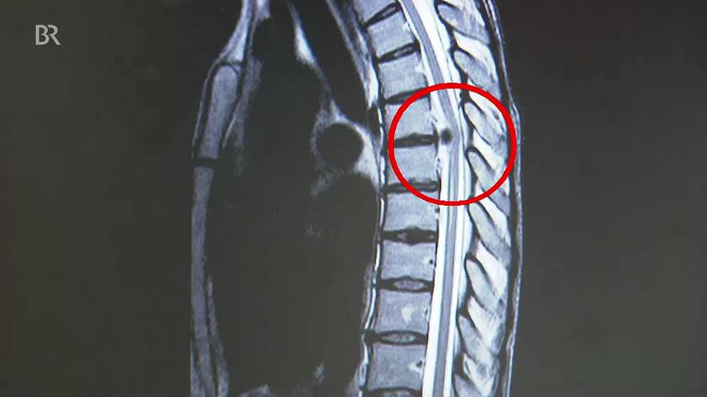 Bandscheibenvorfall: Bandscheibenvorfall Der Brustwirbelsäule ...